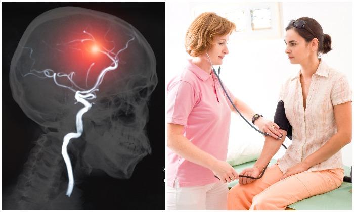 10 Ways to Prevent Stroke–Things You Can Do That May Save Your Life