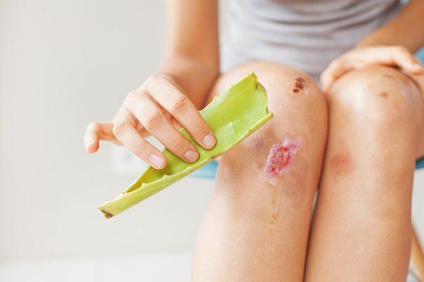Aloe vera is used for wound healing (Mila Supinskaya Glashchenko/Shutterstock)