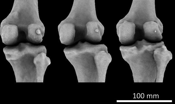 Large (L), medium (C), and small (R) ossified fabellas in the right knees of three female subjects. (Imperial College London)