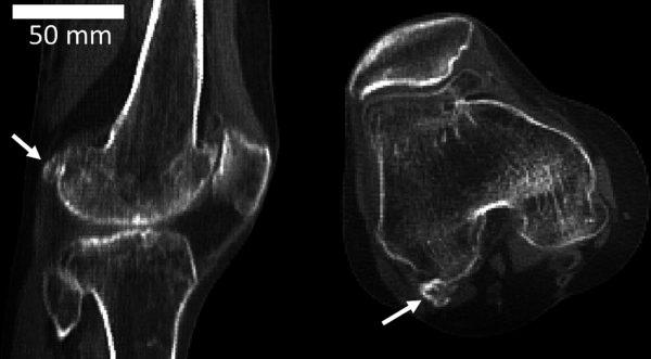 The tiny fabella bone is found in a knee joint tendon. (Imperial College London)