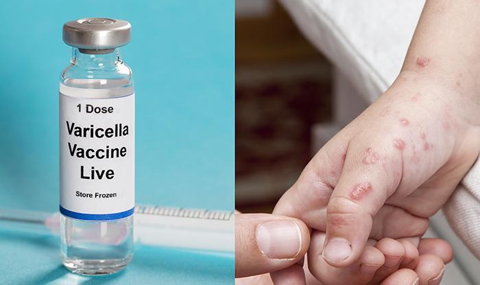 Childhood Shingles Resulting from Chickenpox Vaccination: “Rare” or Predictable?