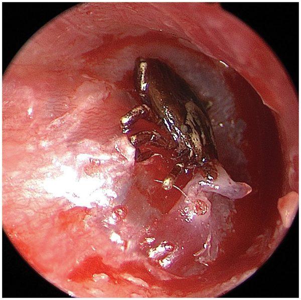 A tick in a 9-year-old boy's ear. (New England Journal of Medicine 2019)
