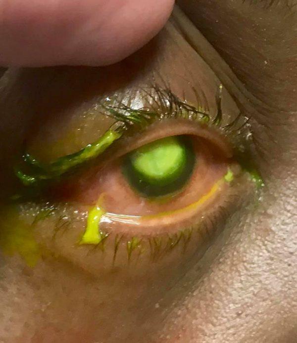 The eye of a patient suffering from pseudomonas infection of the cornea highlighted with fluorescent dye. (Vita Eye Clinic)
