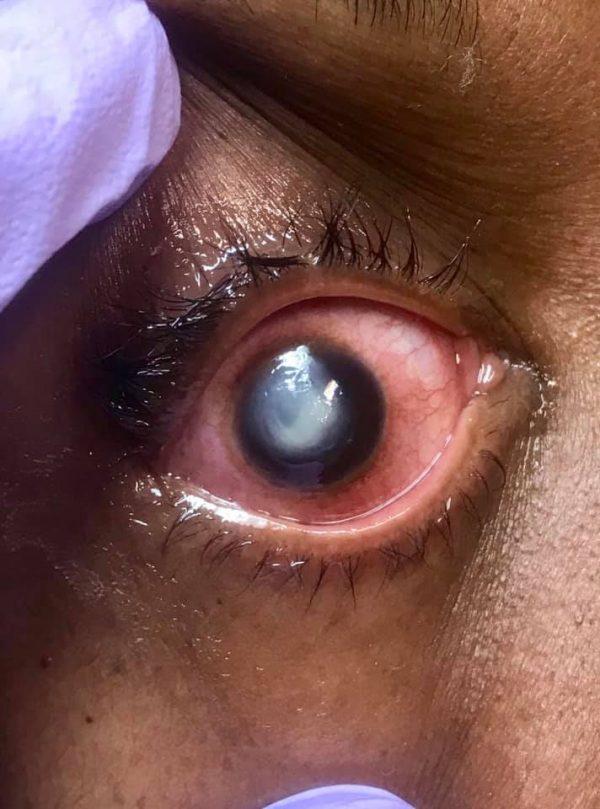 The eye of a patient suffering from pseudomonas infection of the cornea. (Vita Eye Clinic)