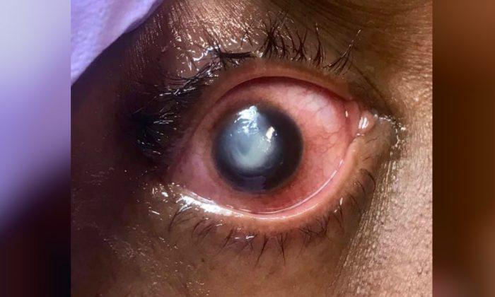 Eye Doctor Shares Graphic Photos as Warning on Sleeping With Contact Lenses