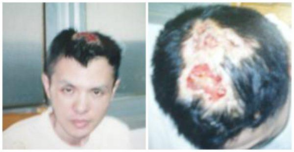 Xiong's skull is exposed from beatings by inmates in the Tilanqiao Prison in Shanghai in 2005. (Minghui.org)