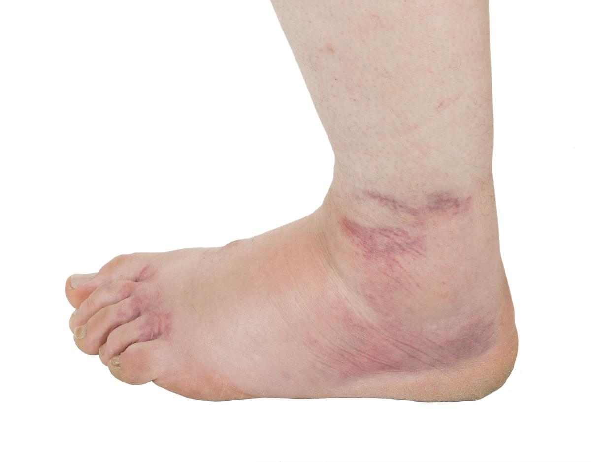 Illustration - Shutterstock | <a href="https://www.shutterstock.com/image-photo/ankle-sprain-85727392">SeDmi</a>