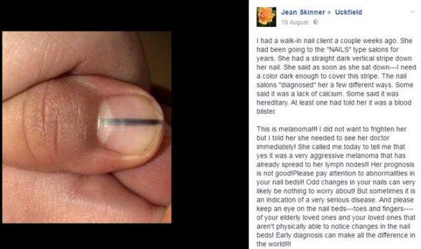 Another woman shared a photo of a line on her nail (Facebook)