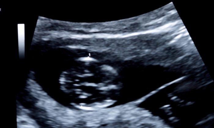 Ultrasound Video Shows Identical Twins’ Hilarious ‘Boxing Match’ in the Womb