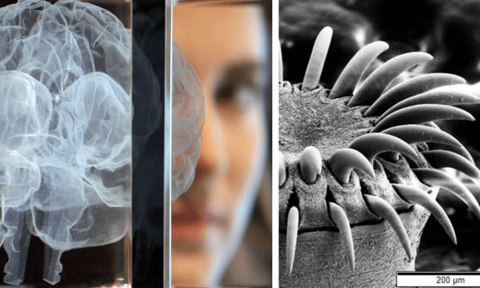 Doctors Operate on ‘Cancer,’ Overjoyed to Find Tapeworm in Woman’s Brain Instead