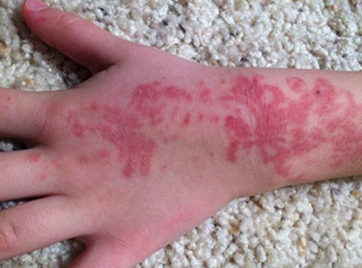 Redness on the hand of an unidentified 5-year-old caused by a henna tattoo, according to the Food and Drug Administration. (FDA/Keith Peterson)
