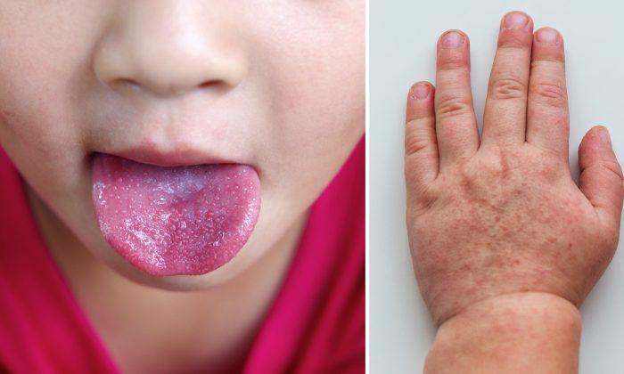 4 Top Tips About Scarlet Fever That Every Parent Should Know