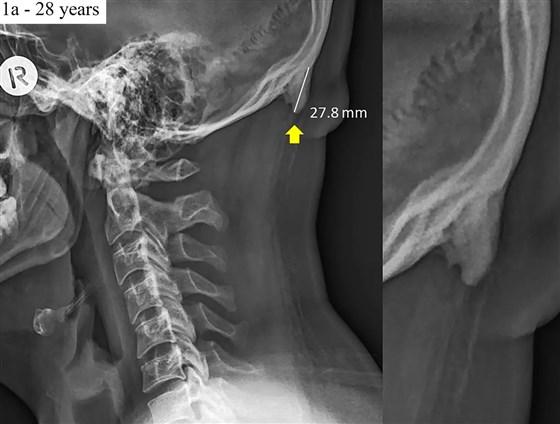 Example radiographs of two male participants (28 years old and 58 years old) showing large spurs at the back of the skull. (Scientific Reports)