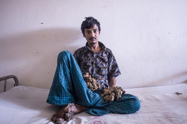 Abul Bajandar sits at Dhaka Medical College Hospital in Dhaka on the day that he asked doctors to amputate his hands on June 24, 2019. (Munir Uz Zaman/AFP/Getty Images)