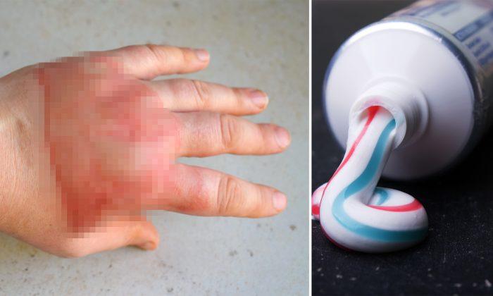 Don’t Use Toothpaste on Burns: Doctor Warns After Woman’s Quick Home Remedy Goes Wrong
