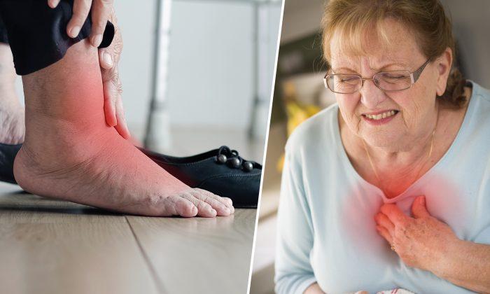 5 Scary Symptoms Related to Swollen Feet–# 5 Can Lead to Heart Failure