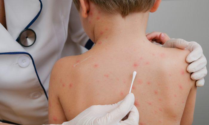 Little Boy With Chicken Pox Cries in Pain, Then Mom Discovers Doctors’ Lethal Mistake