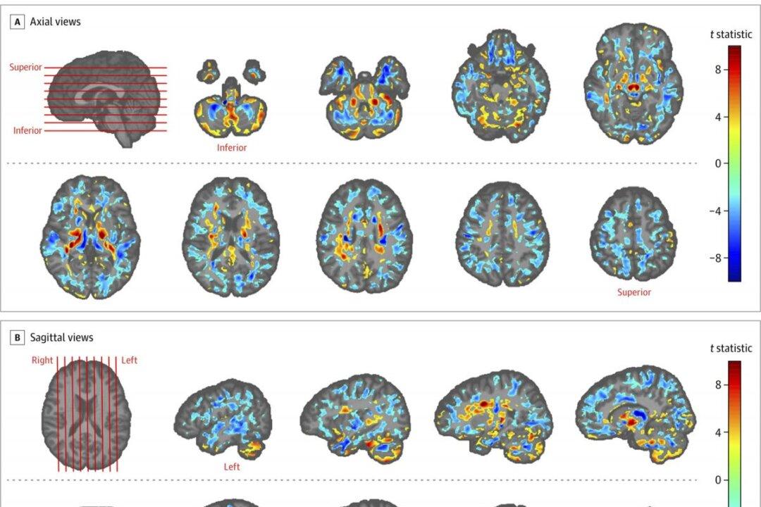 US Diplomats’ Brain Scans Show Differences, Adding to Cuba Mystery