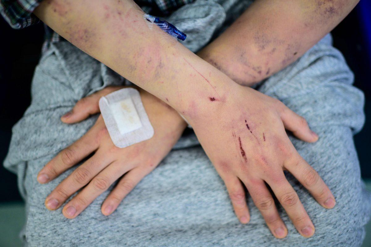 Calvin So, 23, a resident of the rural town of Yuen Long near the border with mainland China, shows his wounds and bruises in a hospital corridor in Hong Kong on July 24, 2019, after he was assaulted on his way back home from a nearby restaurant where he works as a cook by gangs of men on July 21. (Anthony Wallace/AFP/Getty Images)