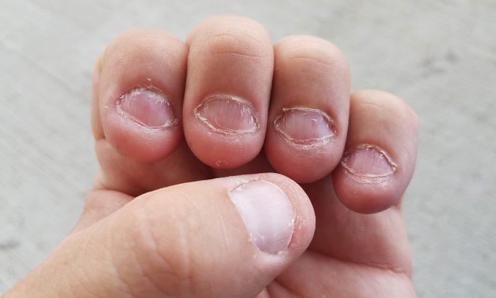 Those Who Bite Nails Aren’t Just Nervous but Have a Special Personality, Find Out More