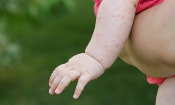 Baby Is Born With Chicken Pox-Like Lumps, but It Turns Out to Be 1-in-100,000 Disease