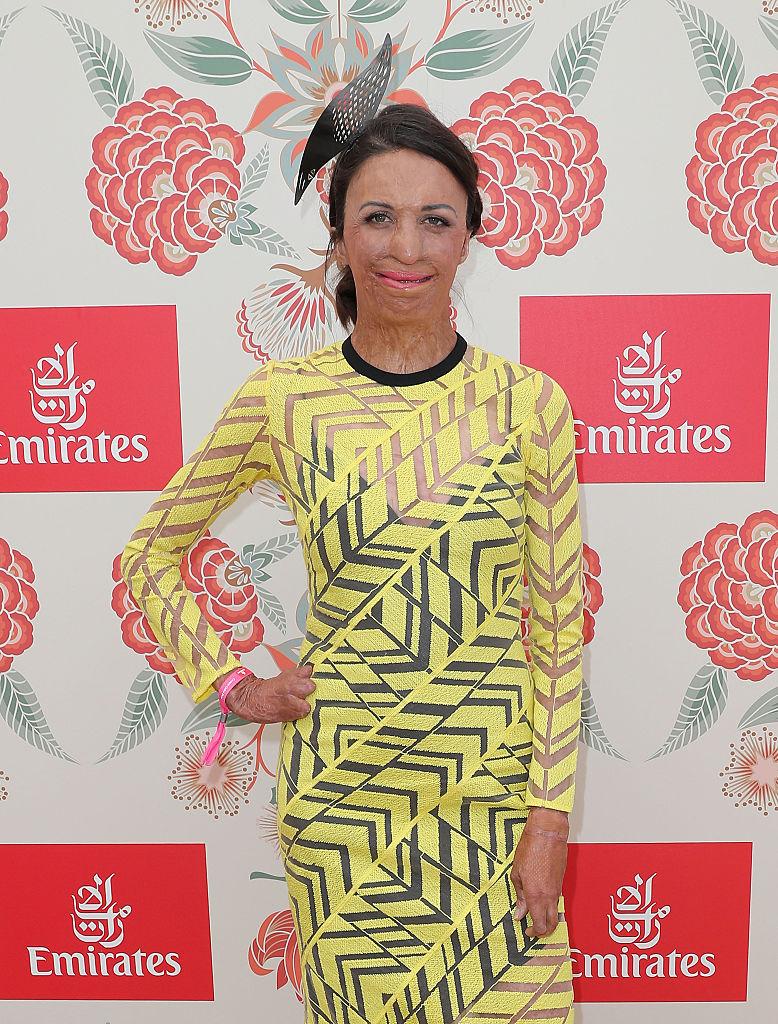 ©Getty Images | <a href="https://www.gettyimages.com/detail/news-photo/turia-pitt-poses-at-the-emirates-marquee-on-oaks-day-at-news-photo/620688530?adppopup=true">Scott Barbour </a>