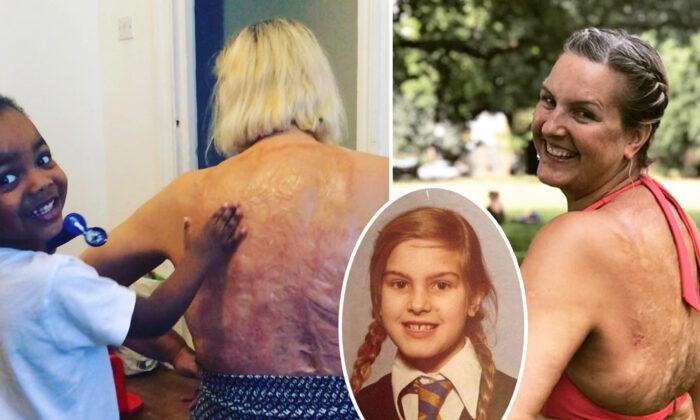 Burn Victim Starts Body-positive Campaign After 47 Years of Shame: ‘My Scars Are Wonderful’