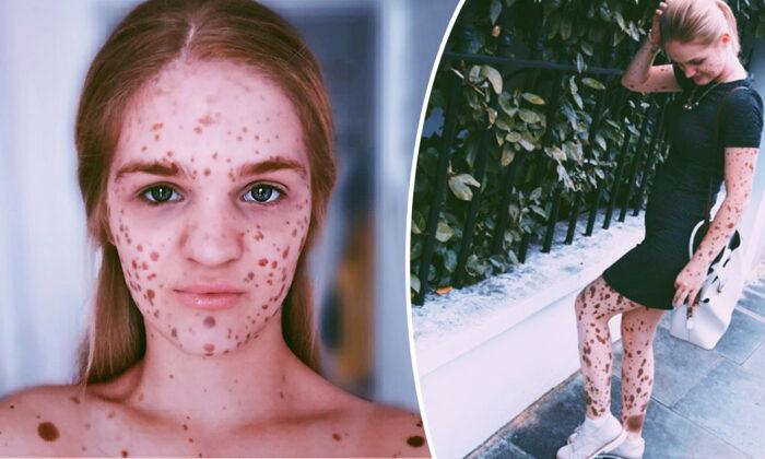 Young Woman Was Bullied for Her Birthmarks–Now She Is a Model and Advocates Body Positivity