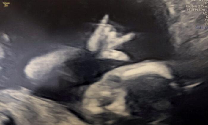 Unborn Baby Surprises Parents With a Heavy-Metal Rock Sign During Week-19 Ultrasound