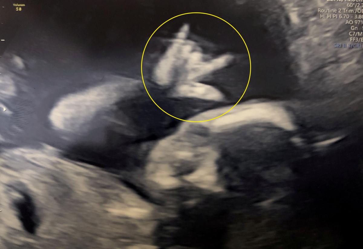 The week-19 baby scan shows Tom Dowie and fiancée Caitlin Welsh's unborn child giving the "sign of the horns." (©SWNS)