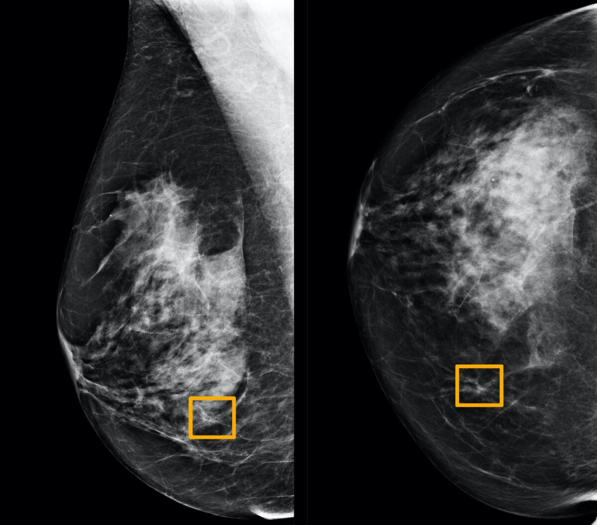A yellow box indicates where an artificial intelligence system found cancer hiding inside breast tissue, in an undated photo released on Jan. 1, 2020. (Northwestern University/Handout via Reuters)
