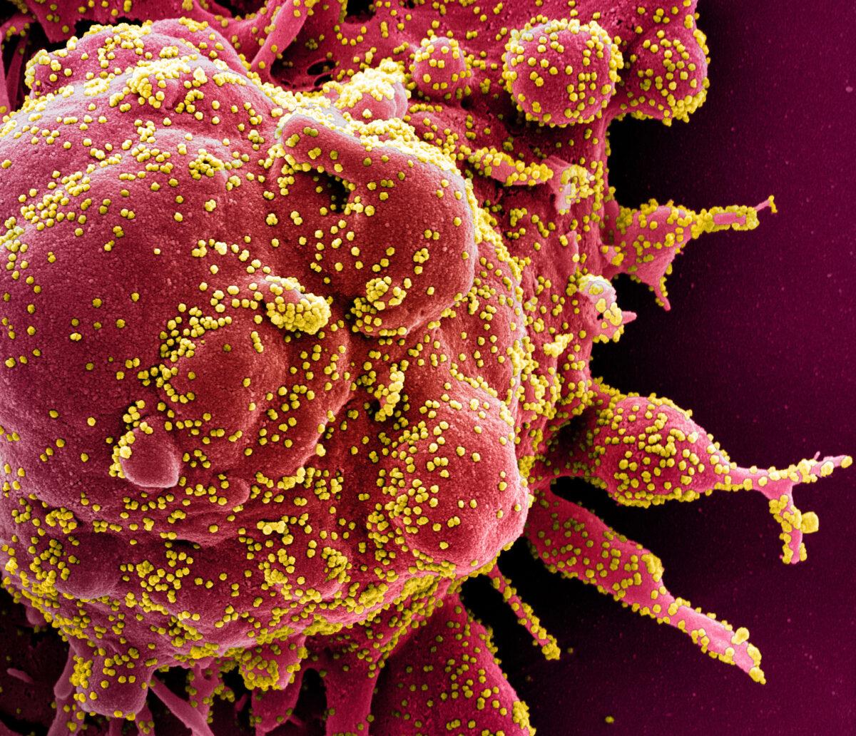 Colorized scanning electron micrograph of an apoptotic cell (red) heavily infected with CCP virus particles (yellow), isolated from a patient sample. Image captured at the NIAID Integrated Research Facility (IRF) in Fort Detrick, Maryland, published on April 2, 2020. (NIAID)