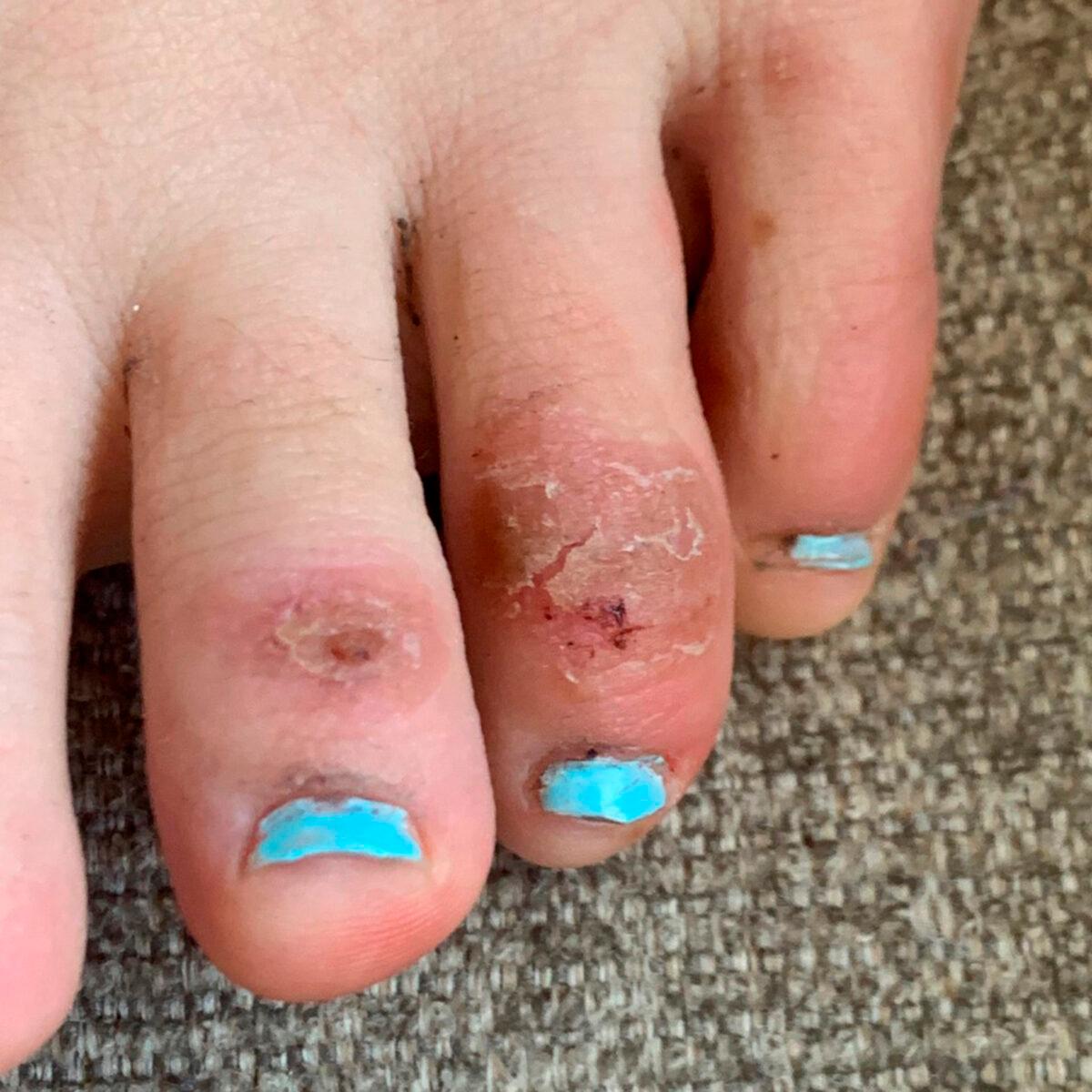 Discoloration on a teenage patient's toes 4 weeks after the onset of the condition informally called "COVID toes" on April 21, 2020. (Courtesy of Dr. Amy Paller/Northwestern University via AP)