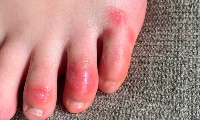 ‘COVID Toes,’ Other Rashes Latest Possible Rare Virus Signs