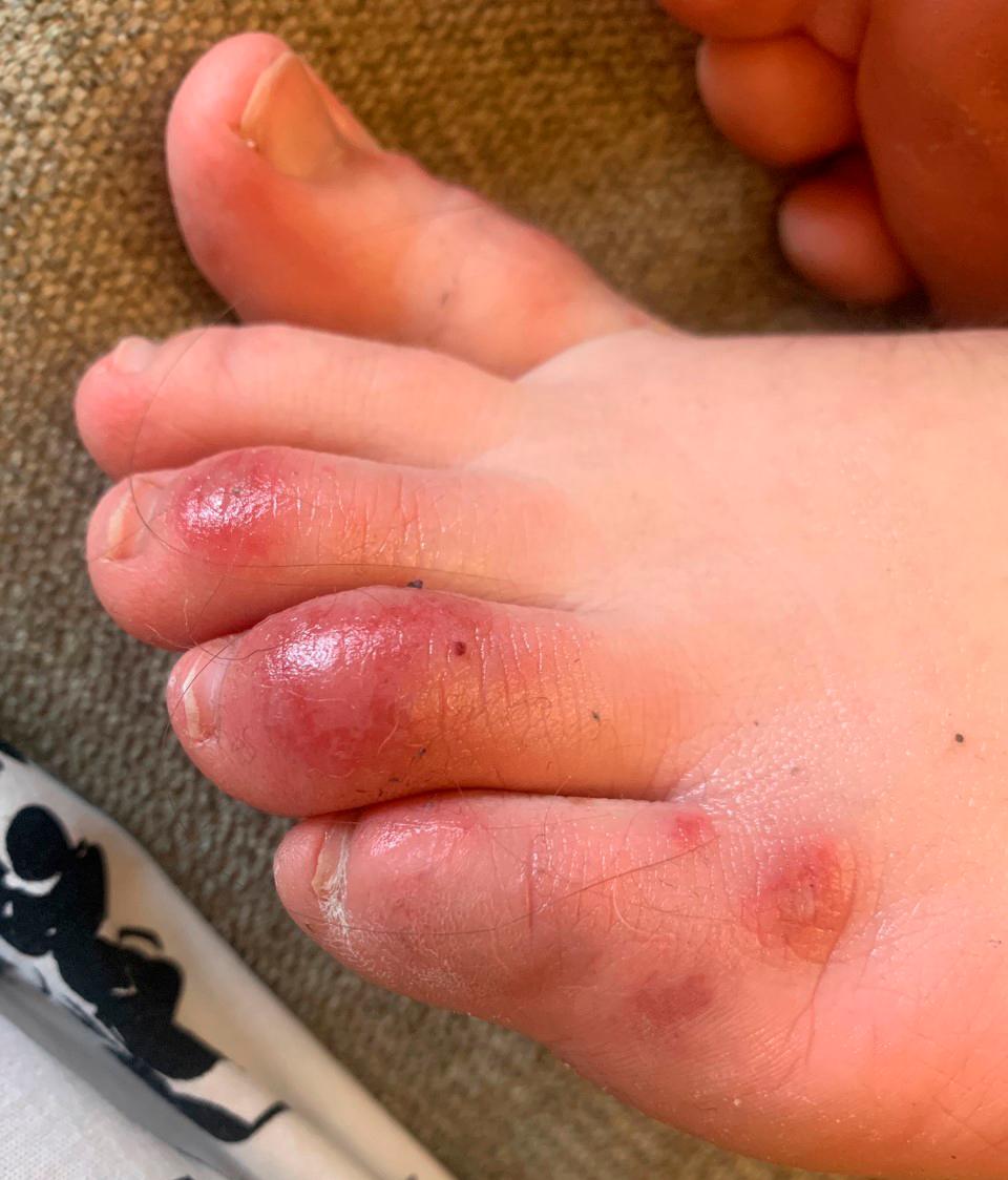 Discoloration on a teenage patient's toes three days after the onset of the condition informally called "COVID toes" on April 6, 2020. (Courtesy of Dr. Amy Paller/Northwestern University via AP)