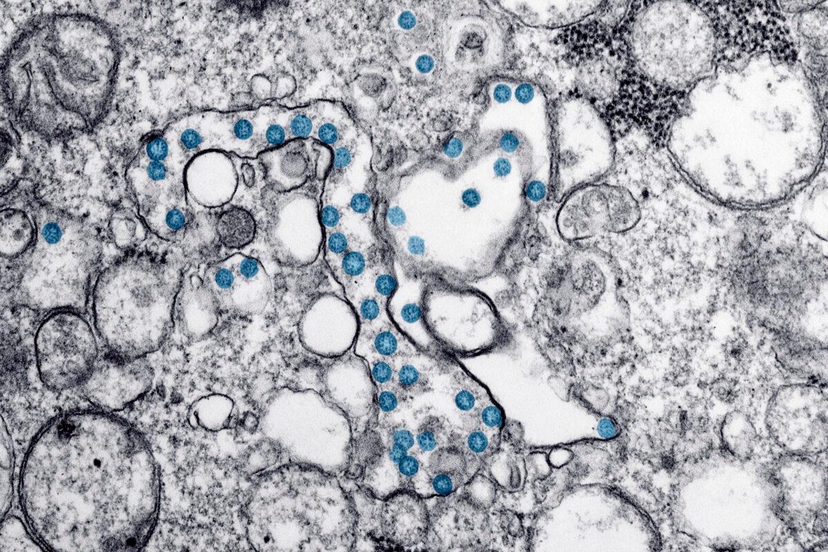 The spherical particles of the CCP virus, colorized blue, from the first U.S. case of COVID-19 in seen in a 2020 electron microscope image made available by the U.S. Centers for Disease Control and Prevention. (AP-Hannah A. Bullock, Azaibi Tamin/CDC via AP/The Canadian Press)