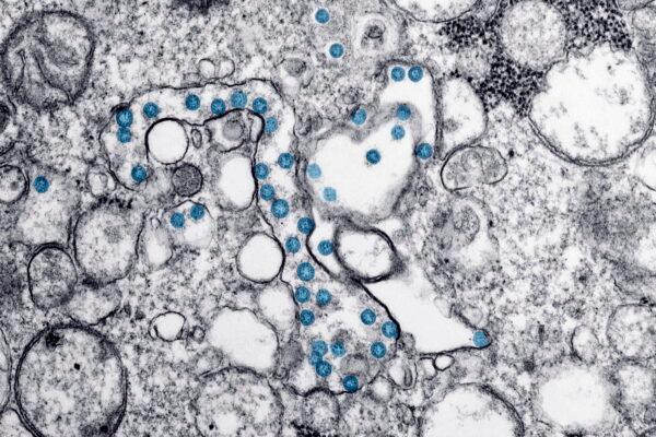 This 2020 electron microscope image made available by the U.S. Centers for Disease Control and Prevention shows the spherical particles of the new coronavirus, colorized blue, from the first U.S. case of COVID-19. (AP-Hannah A. Bullock, Azaibi Tamin/CDC/AP/The Canadian Press)