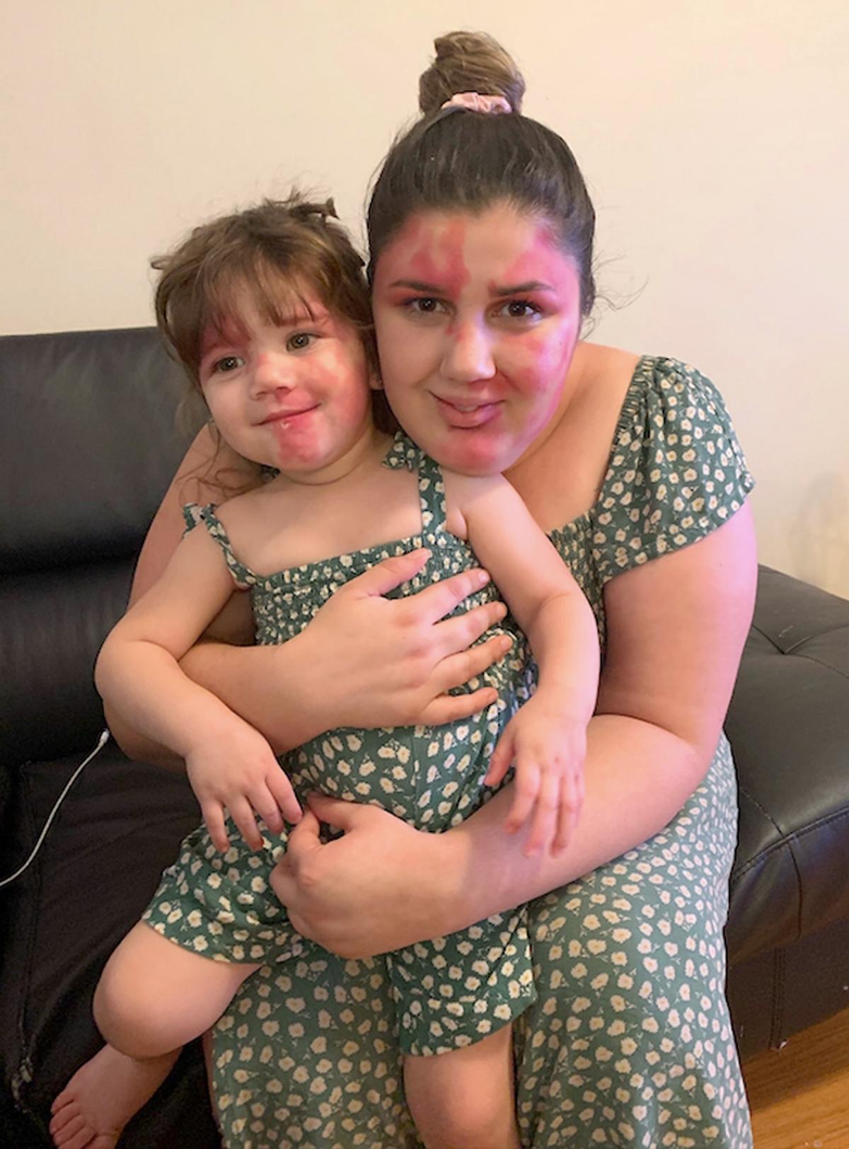 Marianna Bowering matching her daughter Angelica's dress and unique facial birthmark. (Caters News)