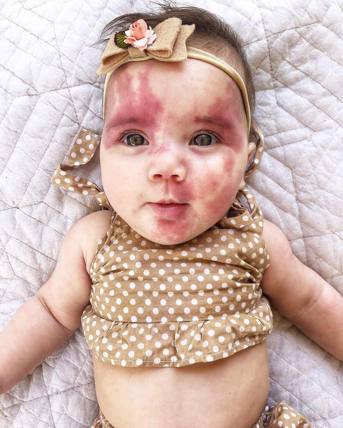 Baby Angelica's port-wine stain birthmark, which her mother calls an "angel kiss." (Caters News)
