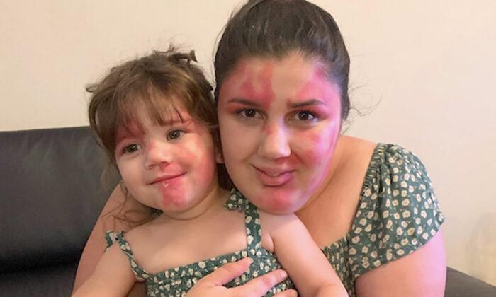 Mom Paints Face to Match Toddler’s Facial Birthmark: ‘I Wanted to Be Just as Beautiful as Her’