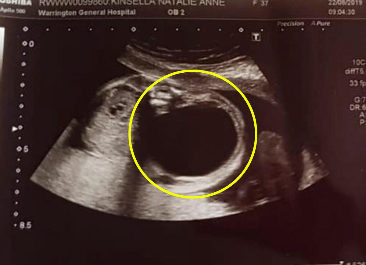 A scan showing the baby's cyst. (Caters News)