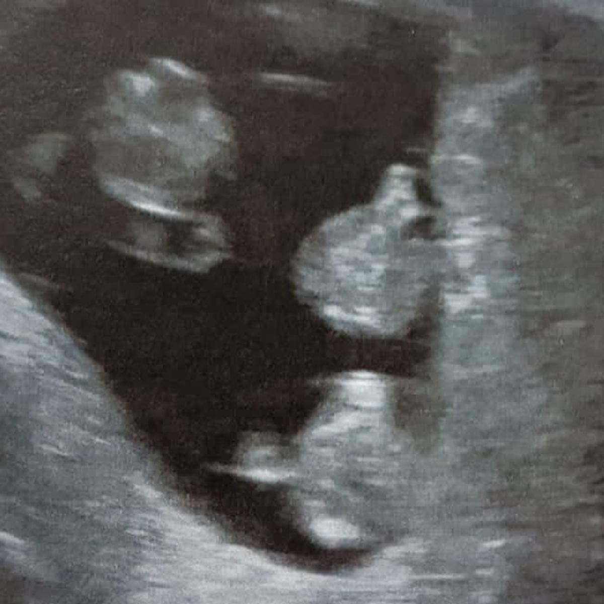 A week-6 scan revealing triplets. (Caters News)
