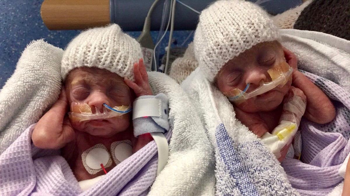 Charlie and Harvey were born prematurely at 24 weeks. (Caters News)
