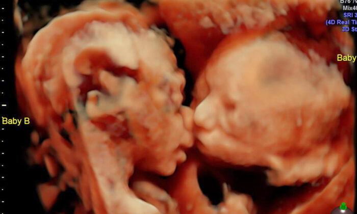 24-Week Sonogram Reveals Unborn Twins ‘Kissing’ in the Womb–and the Photos Go Viral