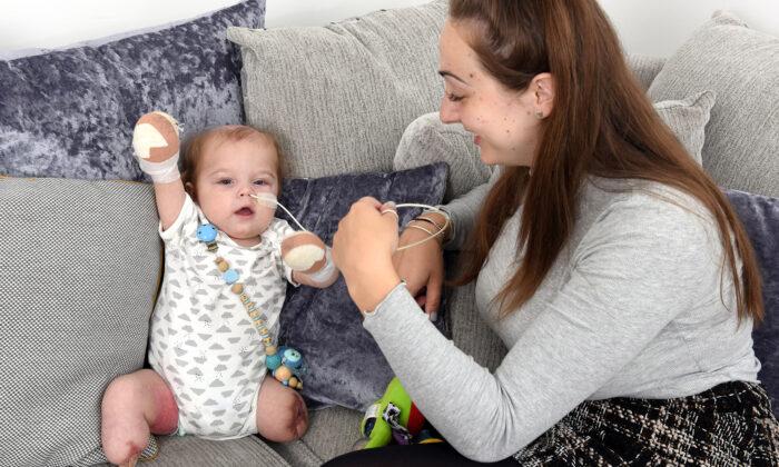 Mom Warns Parents After Baby Loses All Limbs to a Hard-to-Spot Sepsis Infection