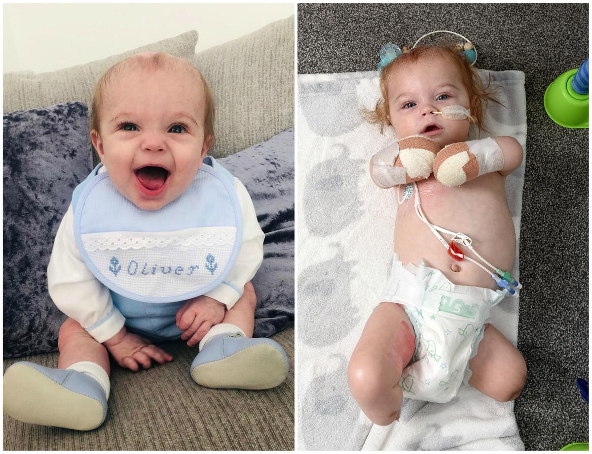 Oliver before and after he had sepsis. (Caters News)