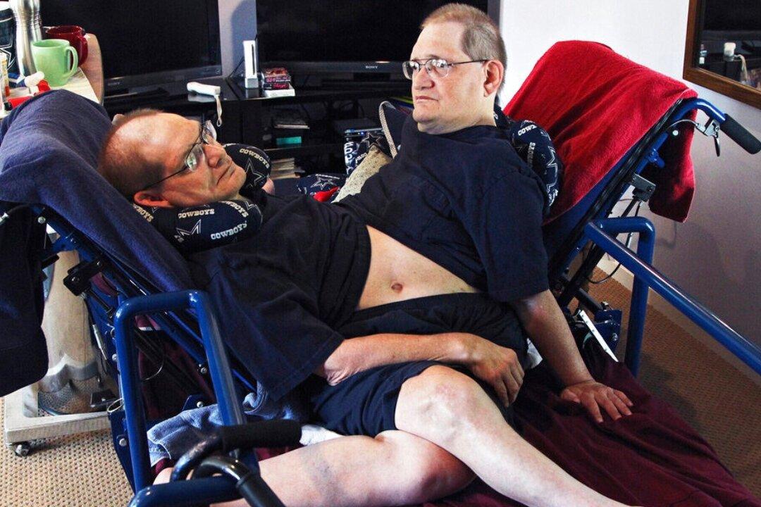 World’s Longest-Surviving Conjoined Twin Brothers Die at 68