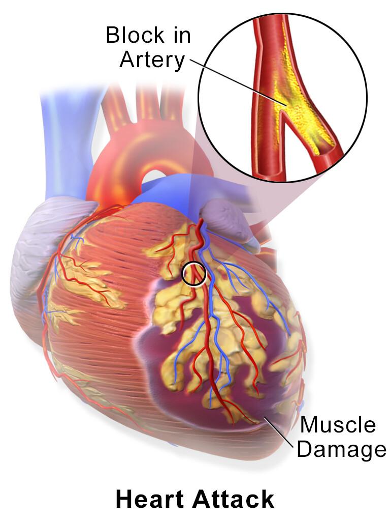 Myocardial Infarction or Heart Attack. (<a href="https://commons.wikimedia.org/wiki/File:Blausen_0463_HeartAttack.png">Blausen Medical Communications, Inc.</a>/CC BY 3.0)