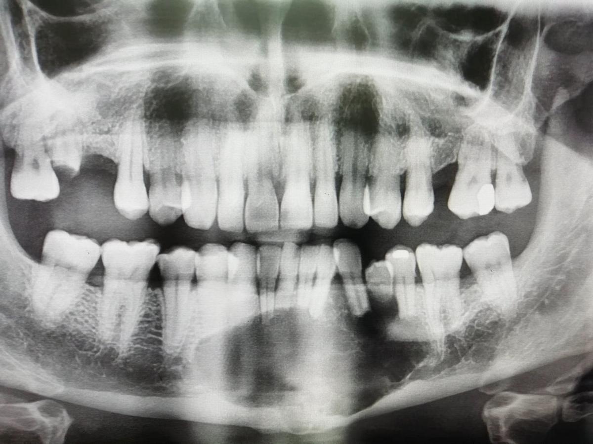 An X-ray of Darren Wilkinson. (Caters News)