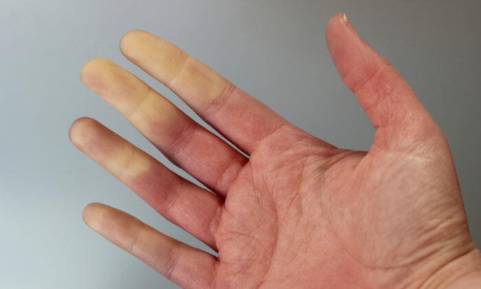 Hands and Feet Going Numb and Changing Color? It Might Be This Disorder:
